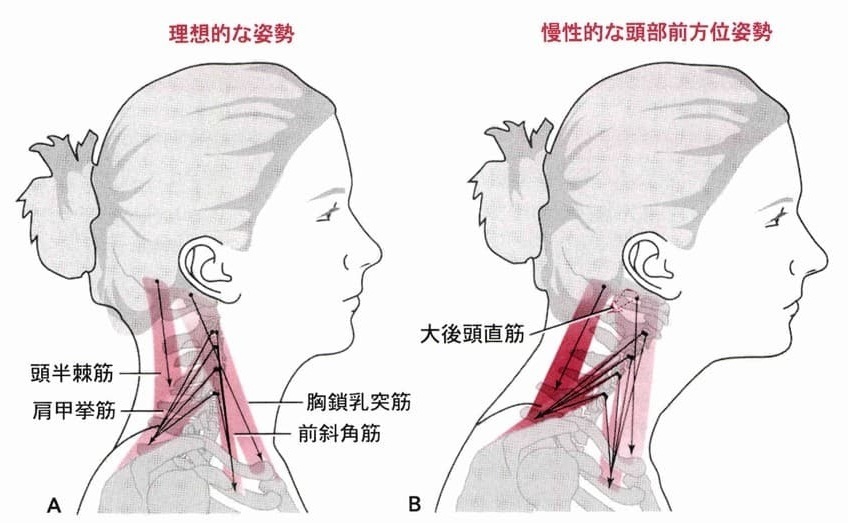 理想的な首の姿勢と慢性的な首の姿勢