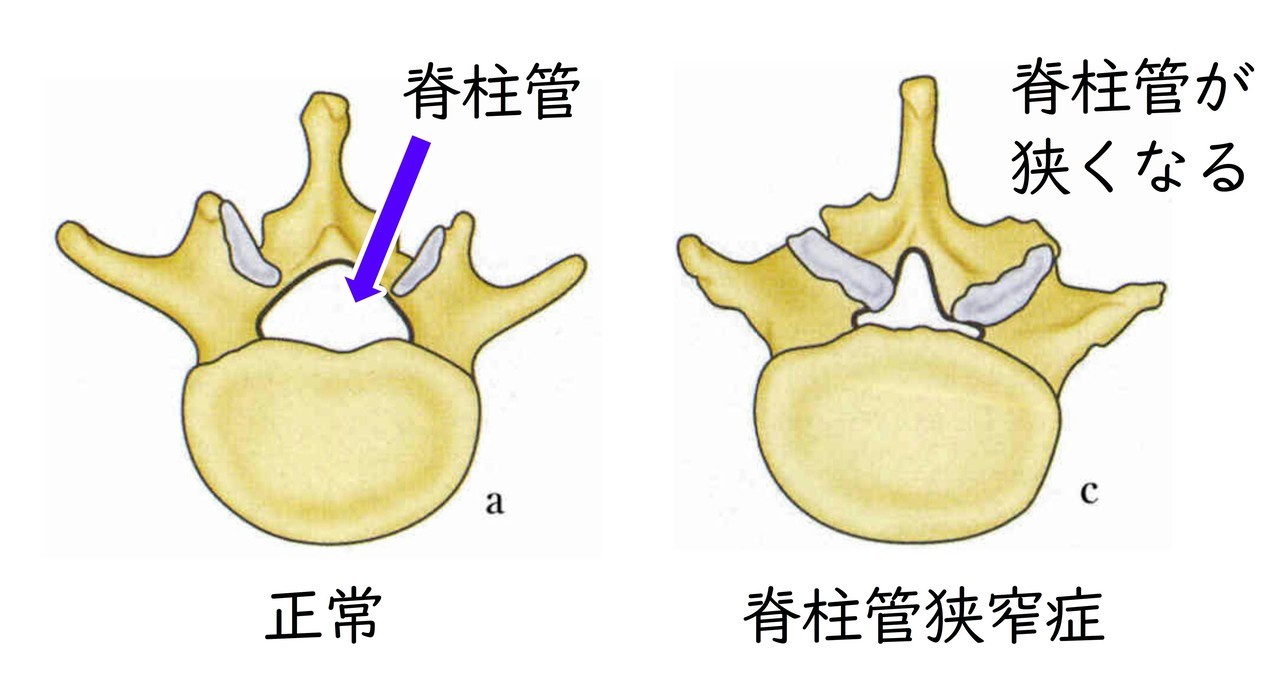 脊柱管狭窄症を説明しているイメージ